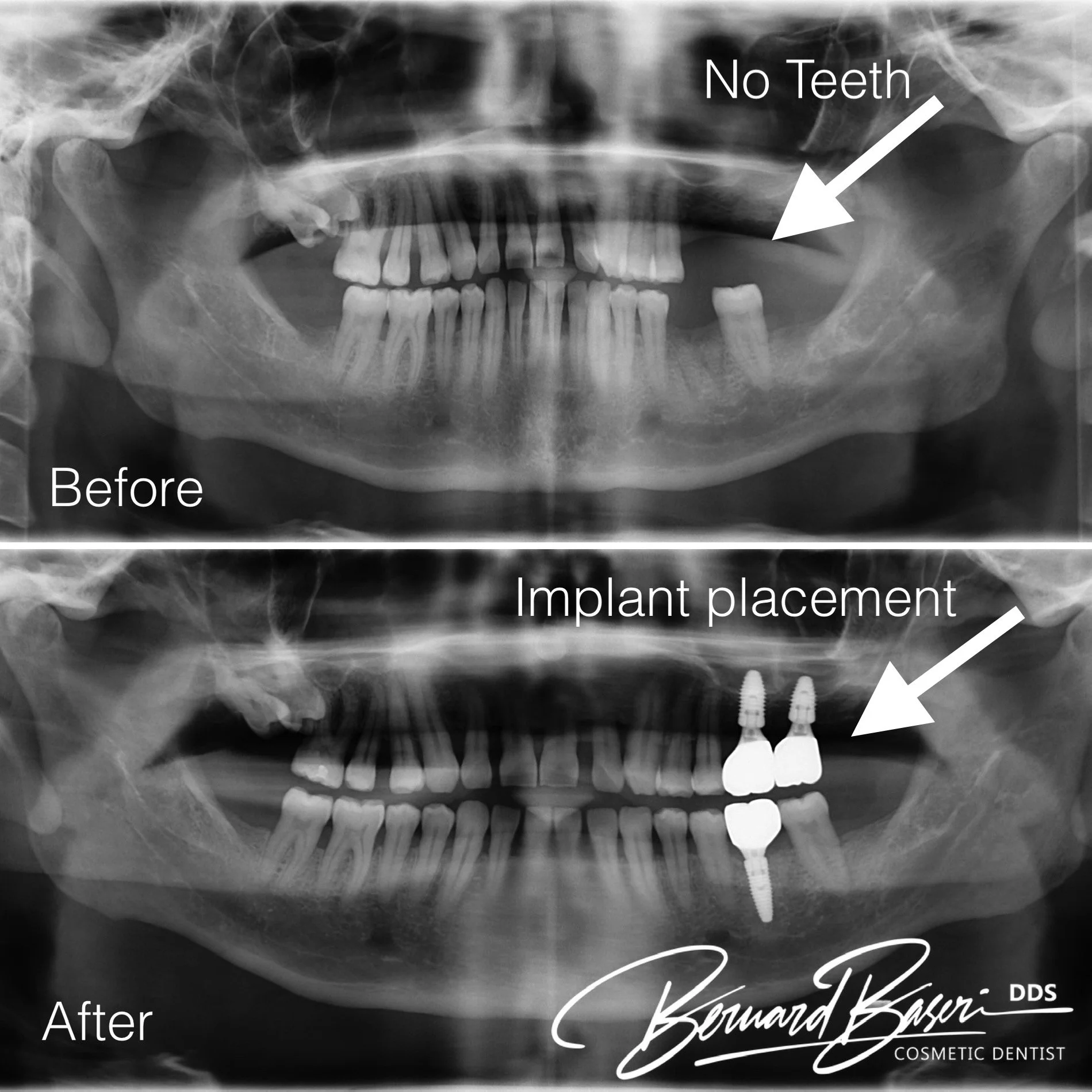Dental Implant Xray