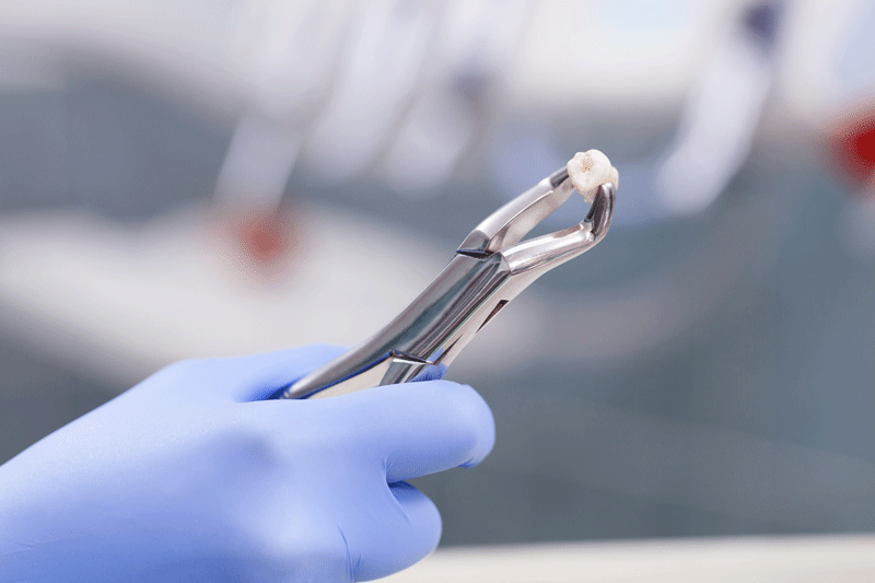 Extraction-Vs-Root-Canal.gif