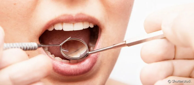 13259-o-tartaro-ja-e-um-problema-para-os-dente-slider_medias-1.jpg