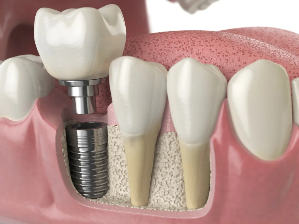 anatomy-of-healthy-teeth-and-tooth-dental-implant-in-human-denturra-picture-id886031480.jpg