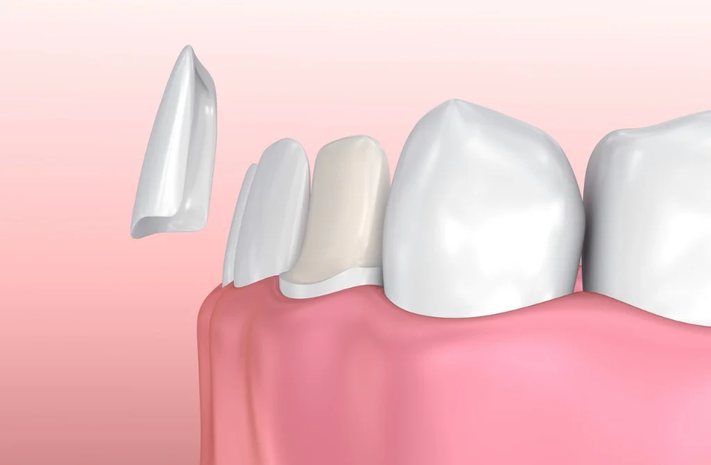 dental-veneers-porcelain-veneer-installation-procedure-picture-id621830860.jpg