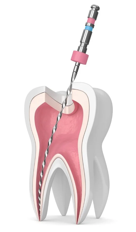 3d-render-of-tooth-with-endodontic-file-picture-id1058709128.jpg