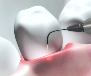 laser+dentistry.jpg