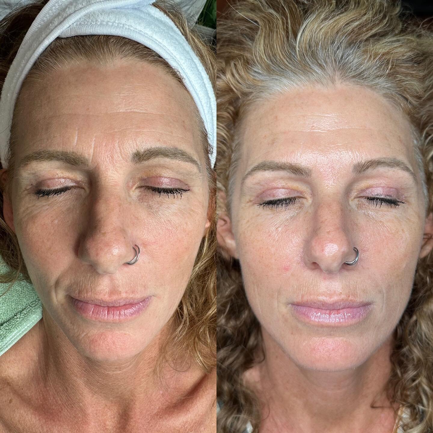 JET PLASMA + Peel 〰️ the proof is in the pics!!

Check out these results after a series of 3 Jet Plasma sessions plus our &lsquo;no downtime&rsquo; Peel from Italy 🤩🤩

Look at the improvement of fine lines, hyperpigmentation, and overall brightness