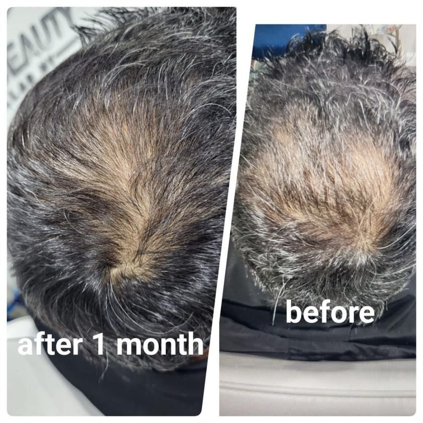 Sera Meso 1 month later after 1 treatment (1).jpg
