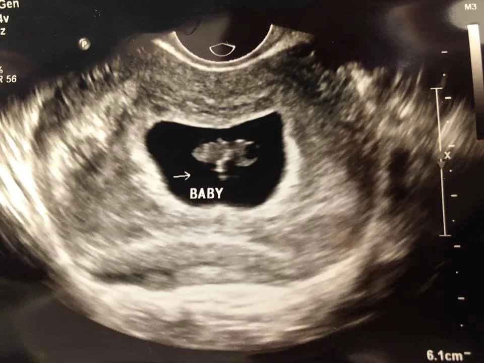 KATIE: WE ARE HAVING A BABY!