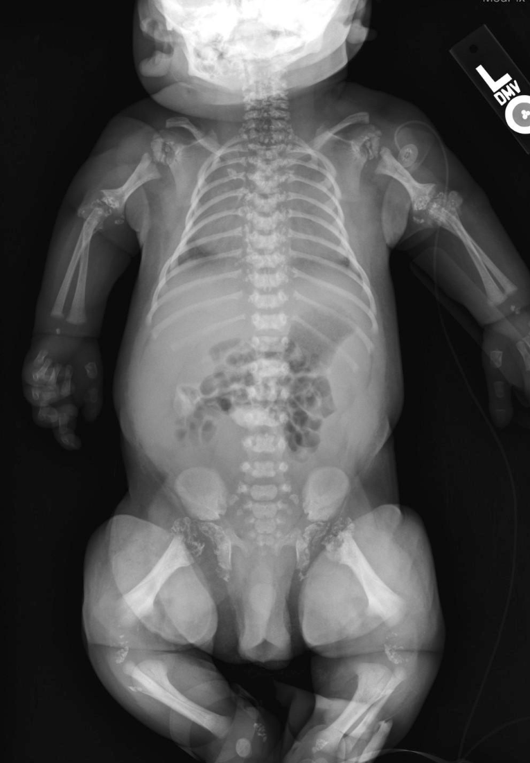 X-ray of an RCP child showing rhizomelia (shortening) of upper long-bones.