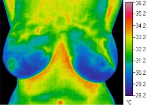 Thermogram 4 months post treatment