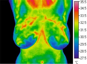 Thermogram: Estrogen Dominance