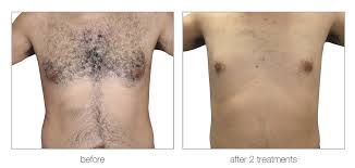 Side by side photographs of a chest labeled before and after two treatments