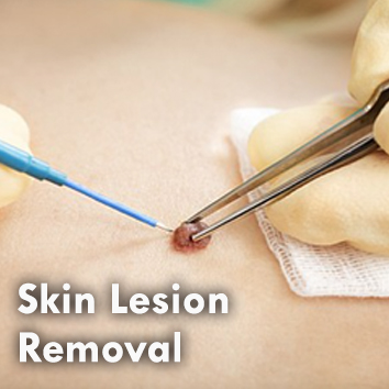 Dermal_Skin Lesion.jpg