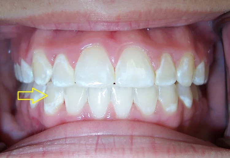 Braces_white_spot_lesions.jpg