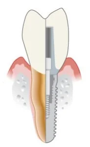 Implant_anatomy.jpg