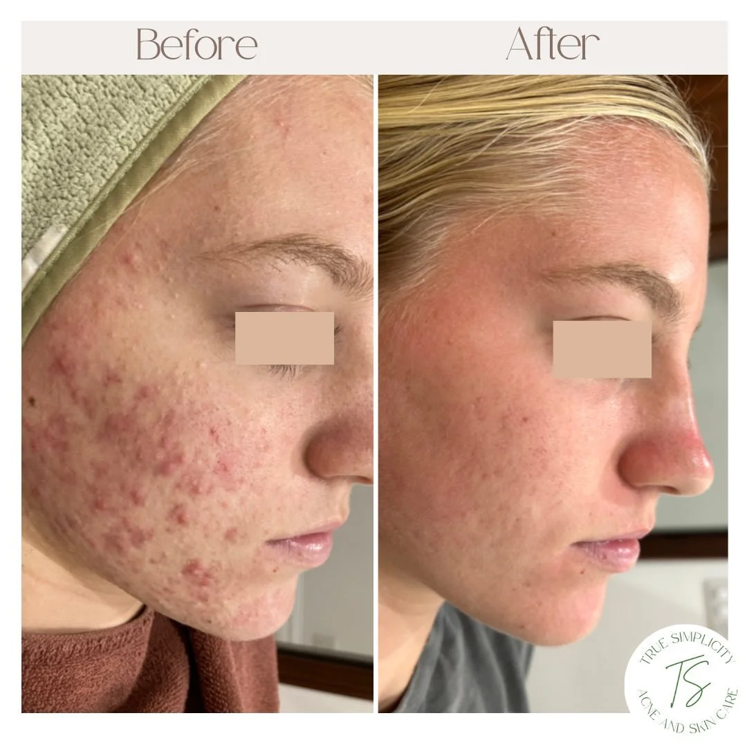 Every face has a story&hellip;

Started with high stress, lack of sleep, whey protein, high-carb/ sugar diet and using products that were drying and irritating the skin.

Ended with managing stress, prioritizing sleep, plant-based protein, a well-bal