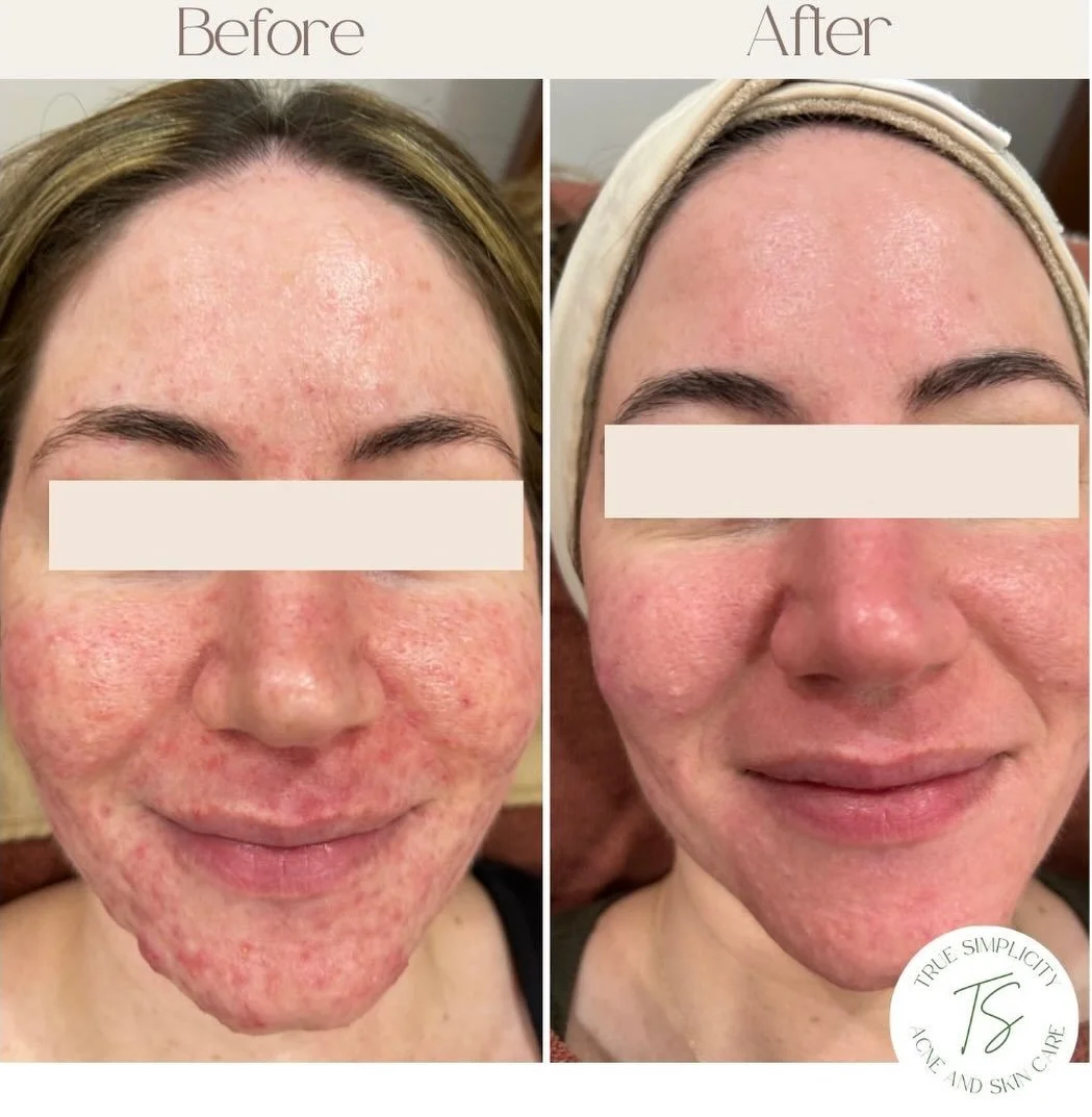 From 14 to 33, she tried it all: every topical, every antibiotic, and every &ldquo;miracle&rdquo; product. After 19 years of struggling with acne, mild PCOS, and gut issues, she finally found what works.
Working with my for just 3 months and focusing