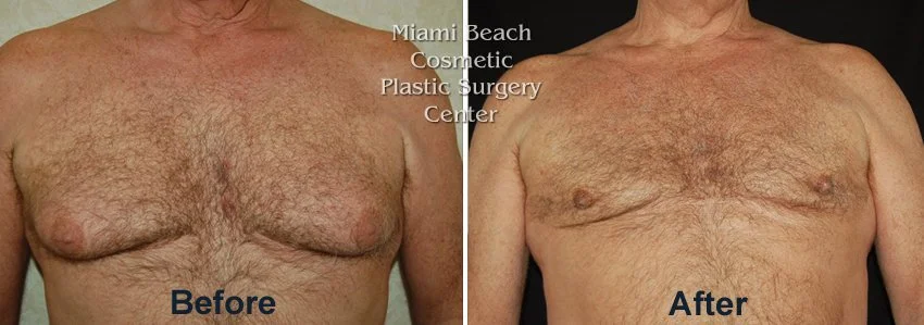 gynecomastia-2.jpg