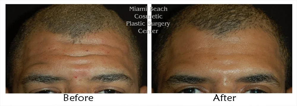 botox2.jpg
