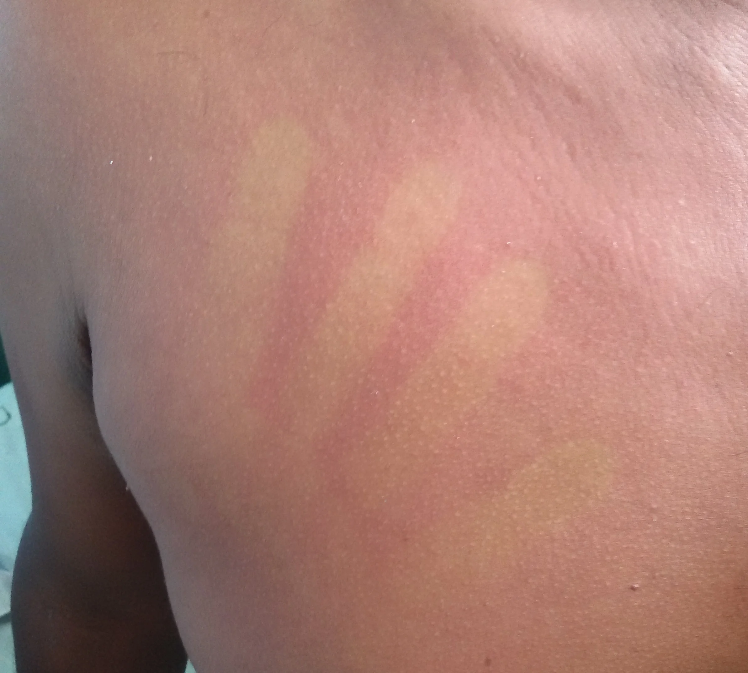 Early dengue fever rash