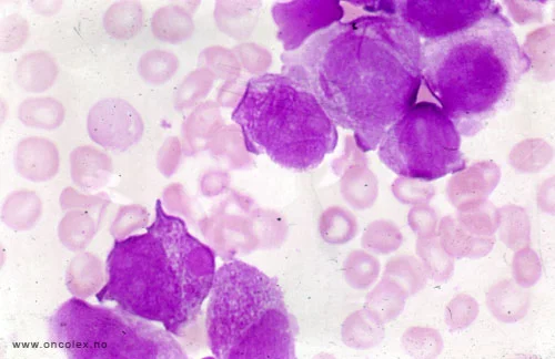 Leukemia In The Philippines