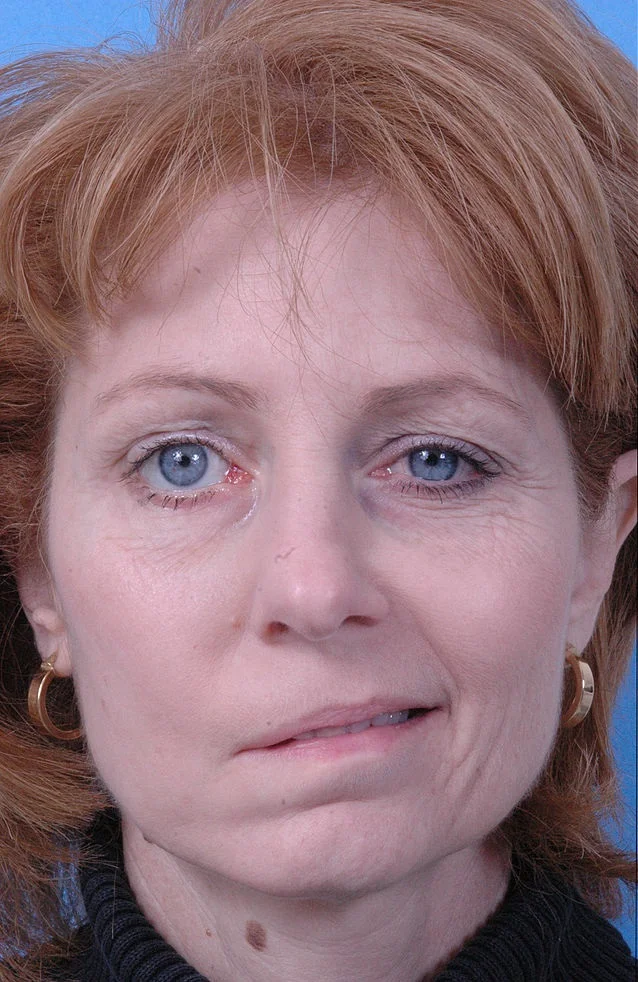 Loss of voluntary control of the facial muscles