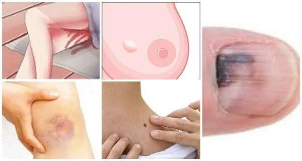 Ways to know if your symptoms might mean cancer