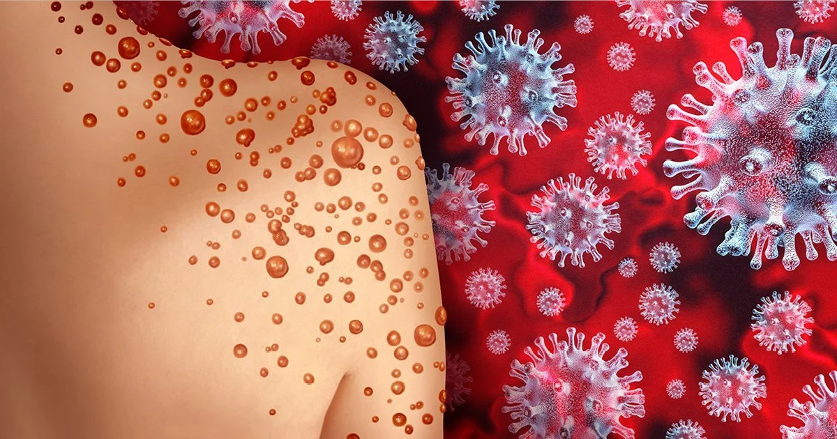 Experts discuss the increase in cases of monkeypox and Lassa fever
