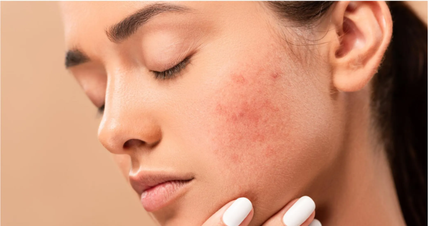 Five Secrets To A Dark Spots-Free Skin