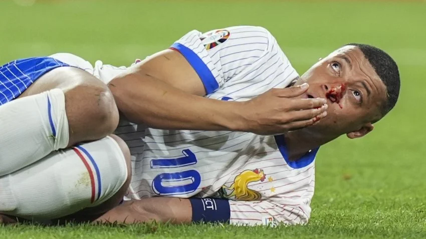 Euro 2024: Mbappe won’t need surgery on broken nose