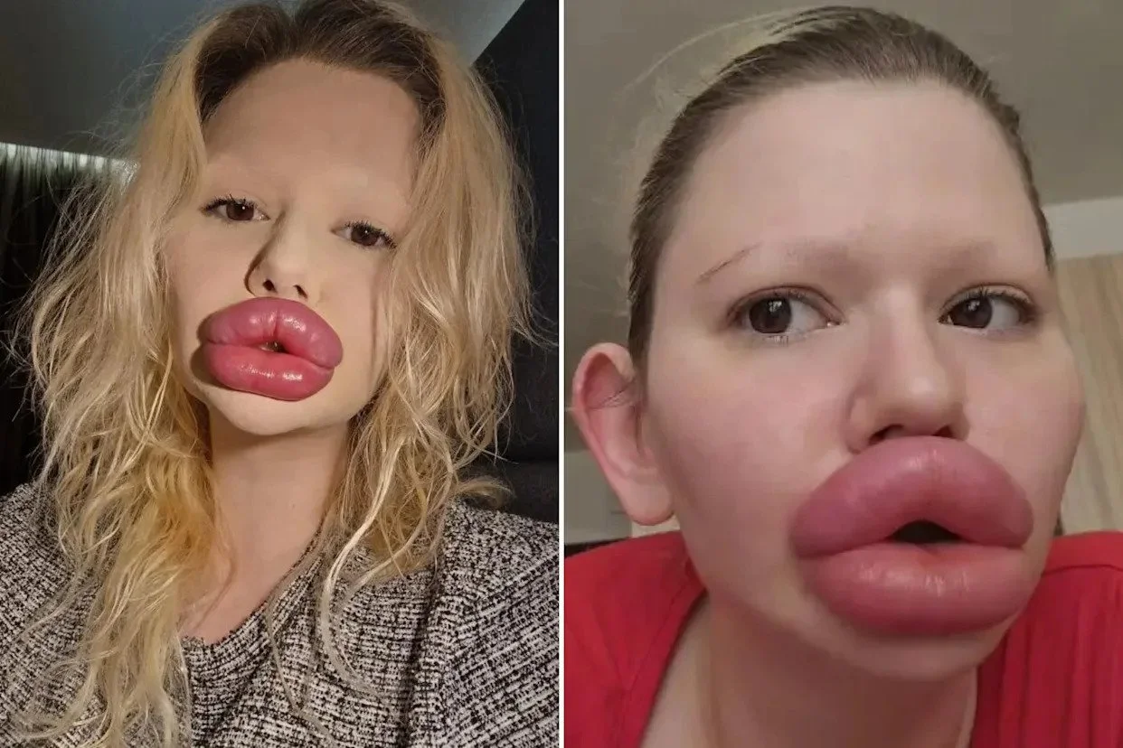  “World’s Largest Lips”: Andrea Ivanova’s Shocking $26,000 Transformation Sparks Global Concern