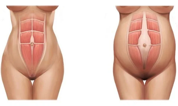 JENPilates_Pilates_StNeots_diastasis recti.jpeg