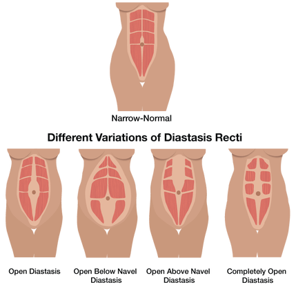 JENPilates_Pilates_StNeots_diastasis recti 1.png