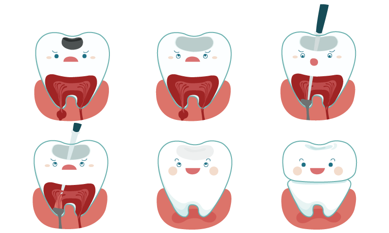 root-canal-in-sudbury.png