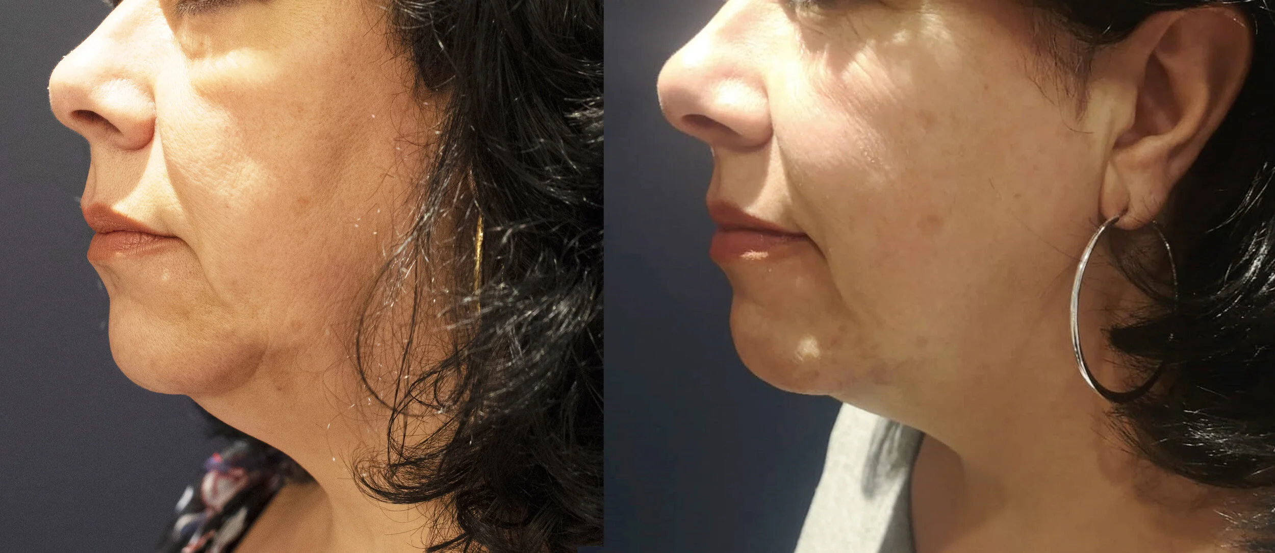 IM_Morpheus8_1b_Before_3monthsAfter+(1).jpg