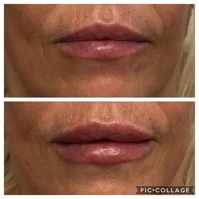 Pretty lip augmentation with one syringe of Versa. We love Versa because it&rsquo;s soft and natural looking.  And, swelling is minimal. ❤️