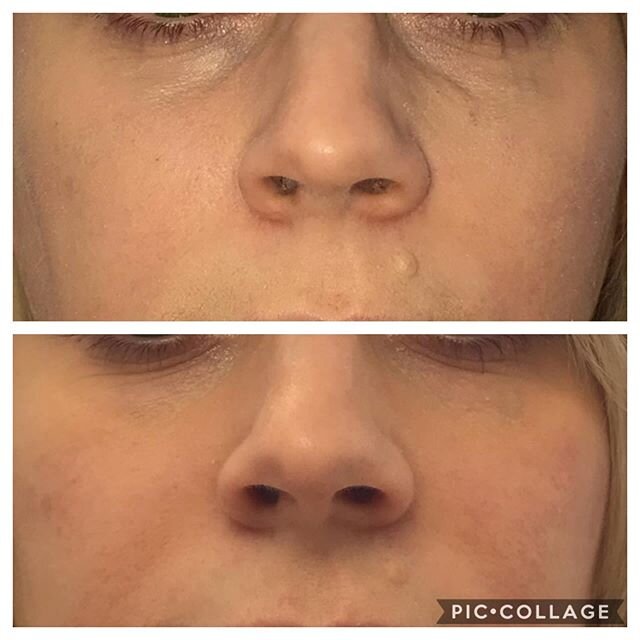 Under eye filler is....well, complicated. It requires patience. We treat over two visits. 1/2 syringe at visit # one and the other half at visit # two two weeks later. Yes, you can bruise. If you don&rsquo;t, you&rsquo;re lucky. Under eye filler last