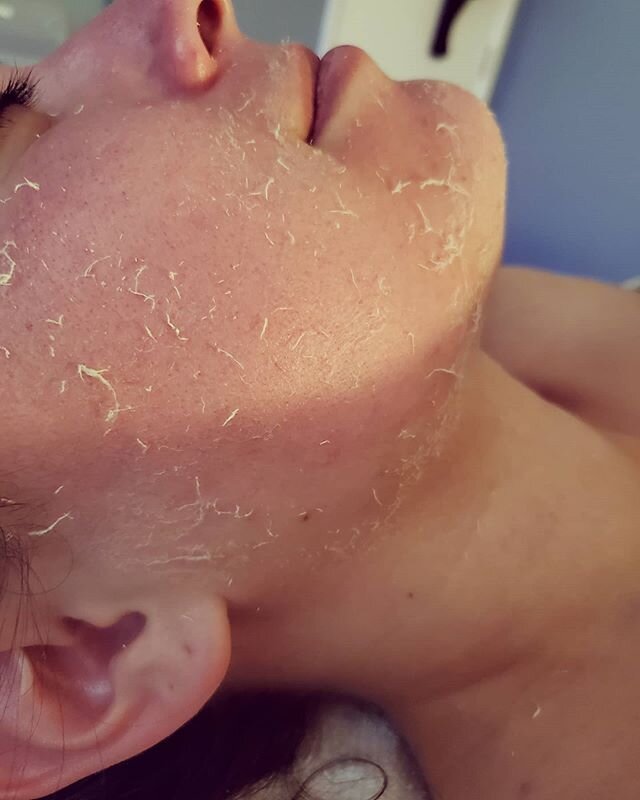 Shedding off that quarantine skin🐍
#pacificbeach #pb #sandiego #sd #skinisin #skintuition #skincare #selfcare #selflove #smallbusiness #skinisin #hydrate #glow #freshskin #antiaging #facials #dmk #oxygenate #radiate