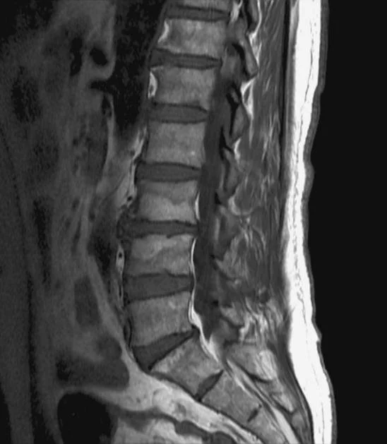 What are Modic type 1 and 2 changes on spine MRI? — The Body Works Clinic