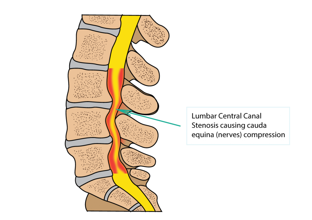 What is Spinal Stenosis and Can Chiropractic Help ? — The Body Works Clinic
