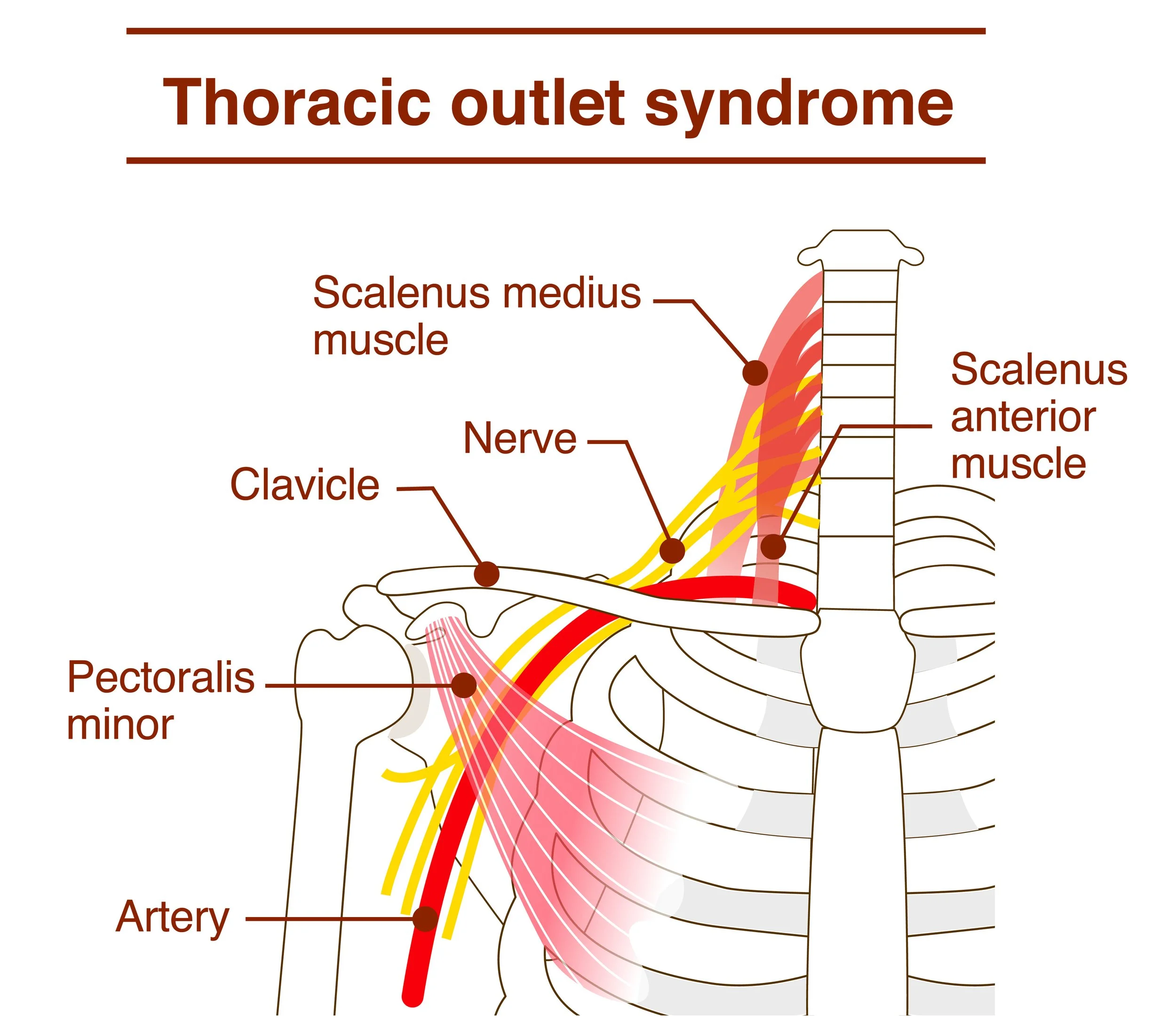WHAT IS THORACIC OUTLET SYNDROME