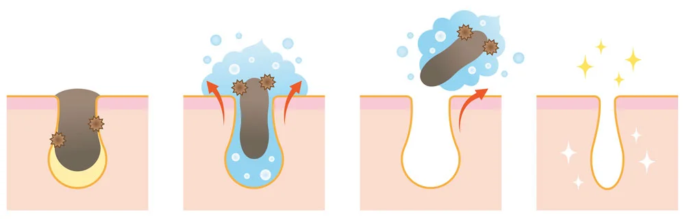 hydrafacial-eliminate-clogged-pores-kansas-city-dermatology.jpg