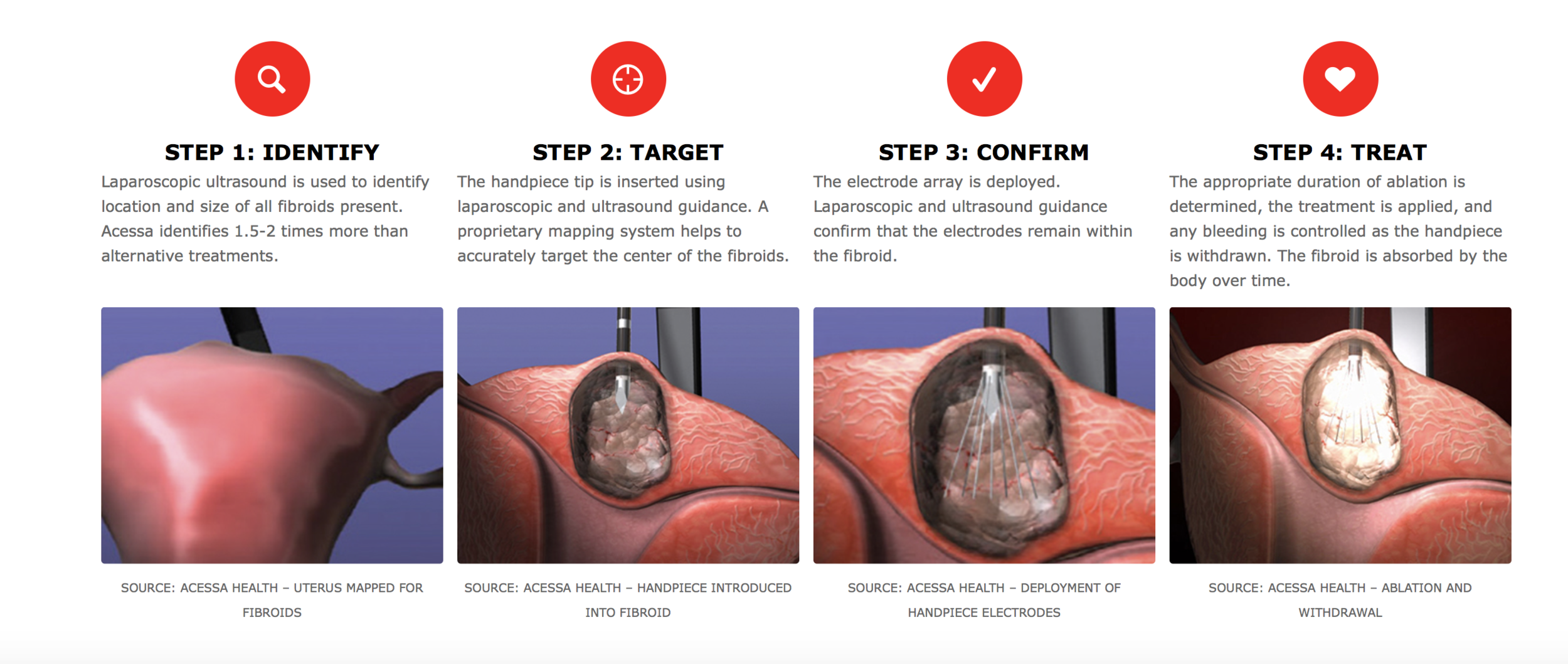 Taken from https://acessaprocedure.com/acessa-procedure-overview/