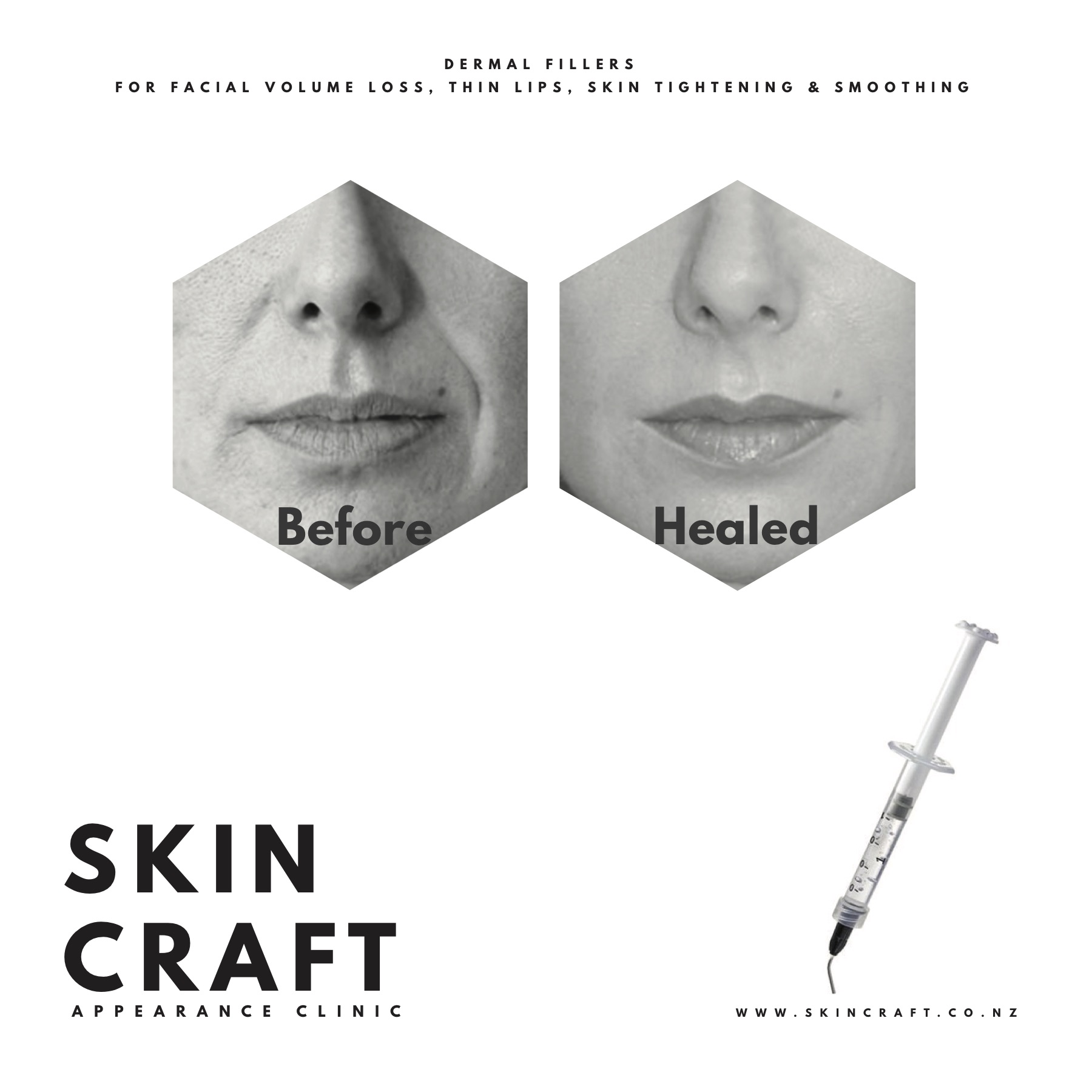 Dermal Fillers.jpg