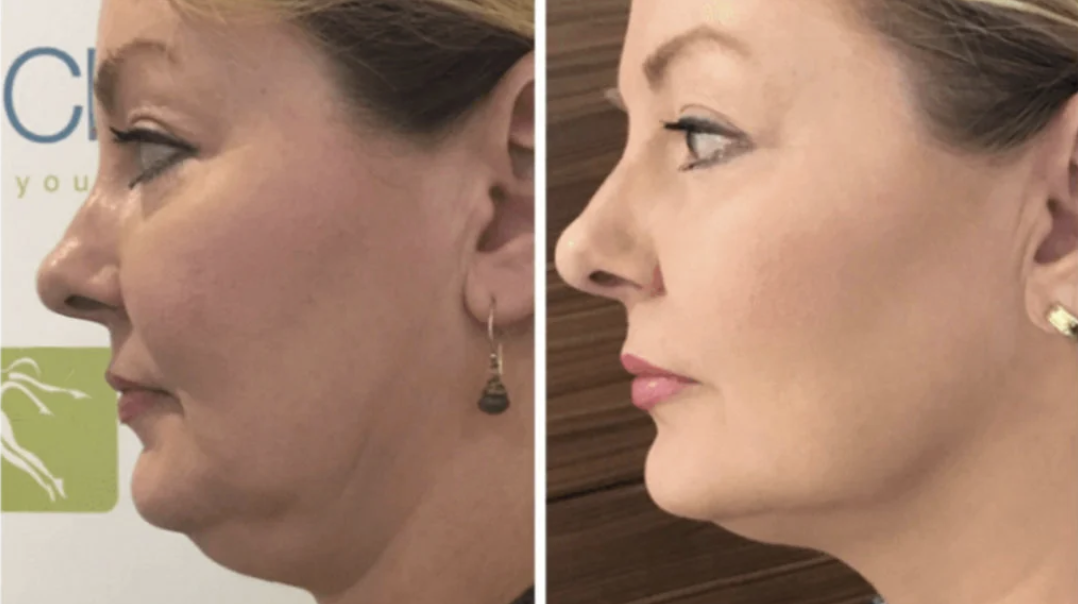 Non-Invasive Facelift: HIFU Before and After Patient Experiences