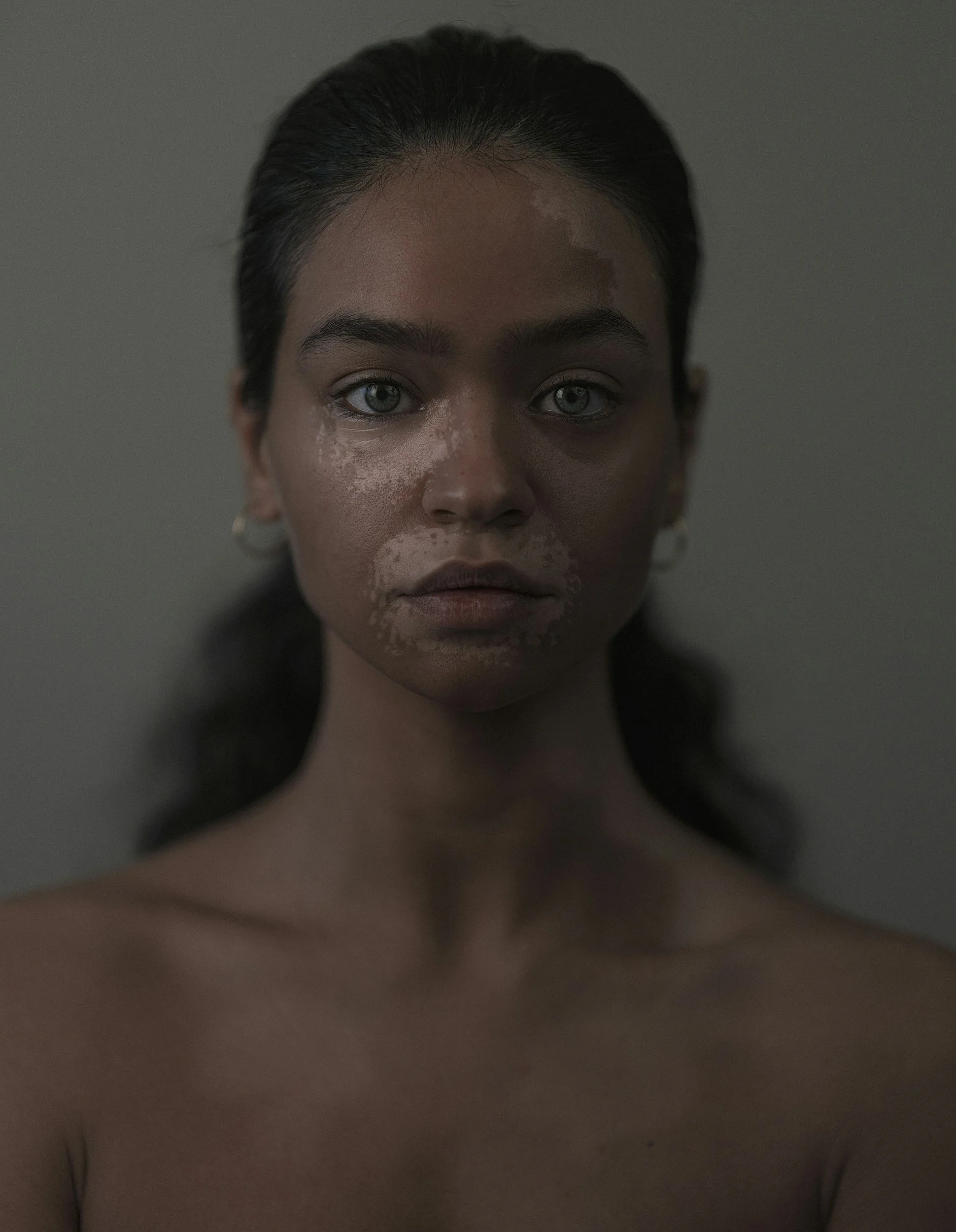 Does vitiligo go away?