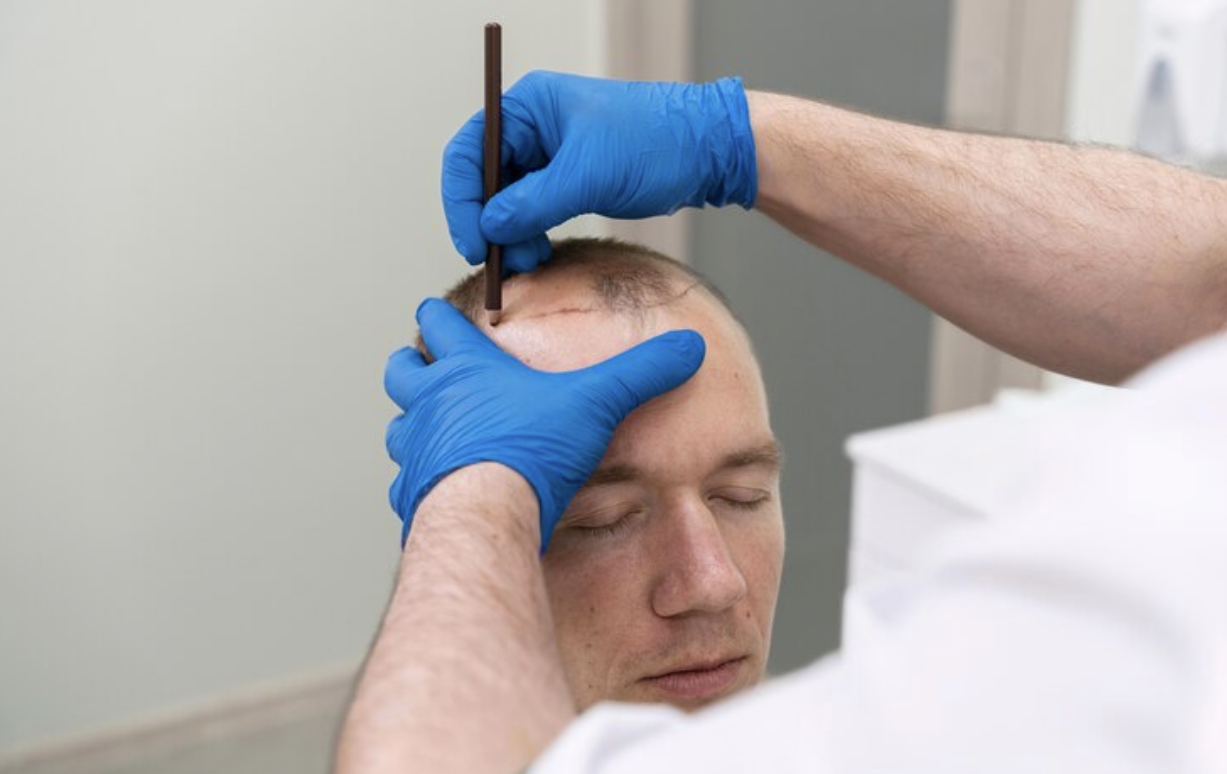 What Makes Scalp Micropigmentation the Best Solution for Hair Loss? 