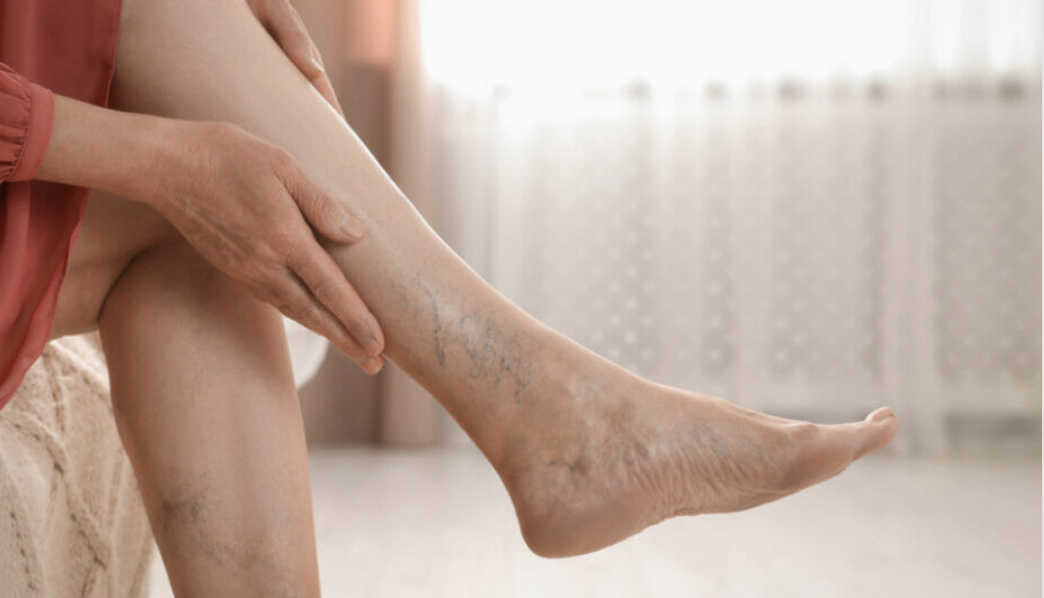 Effective Varicose Vein Removal Options: Explore the Latest Solutions