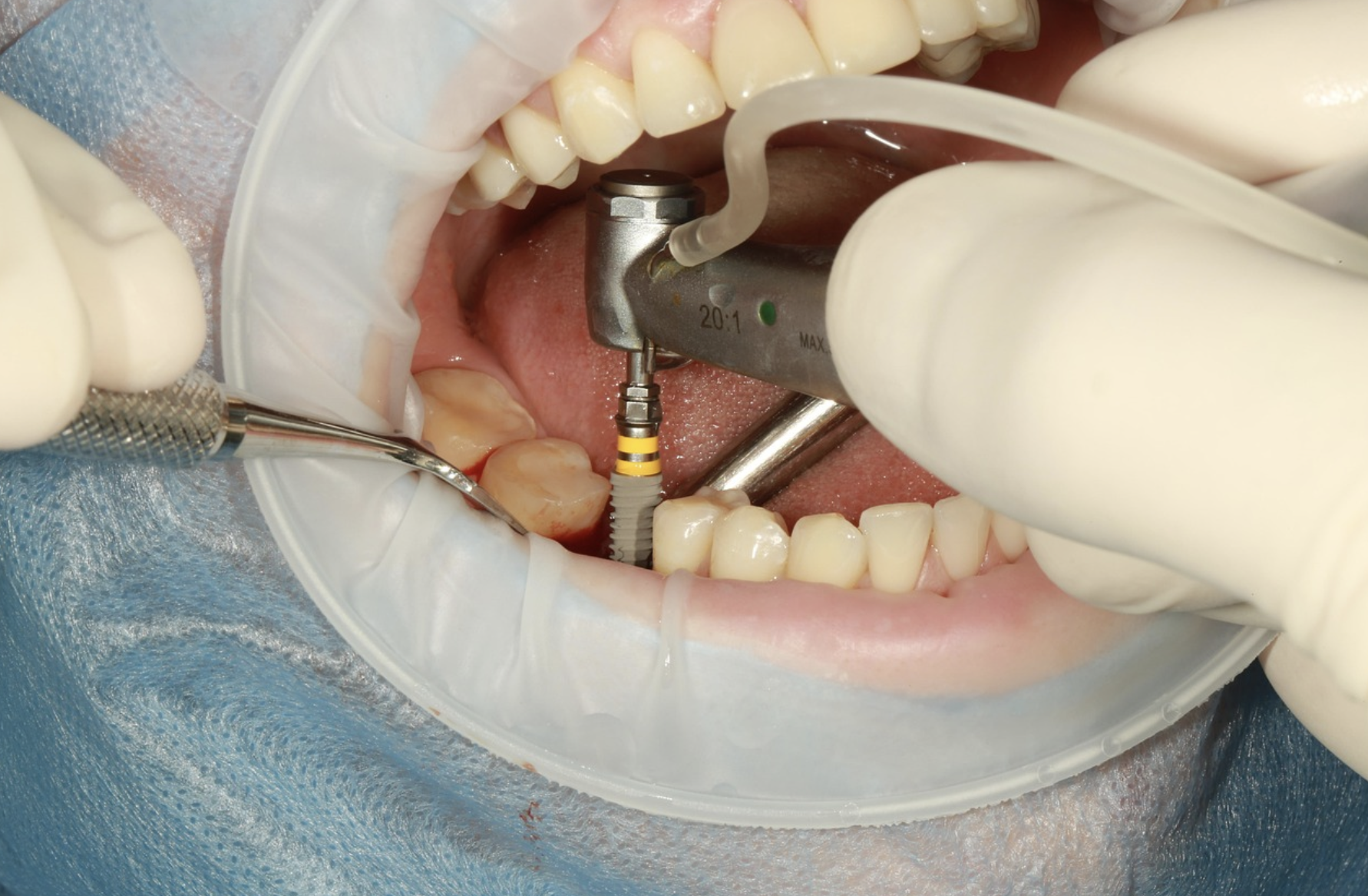 Which Teeth Replacement Option is Right for You? A Complete Guide