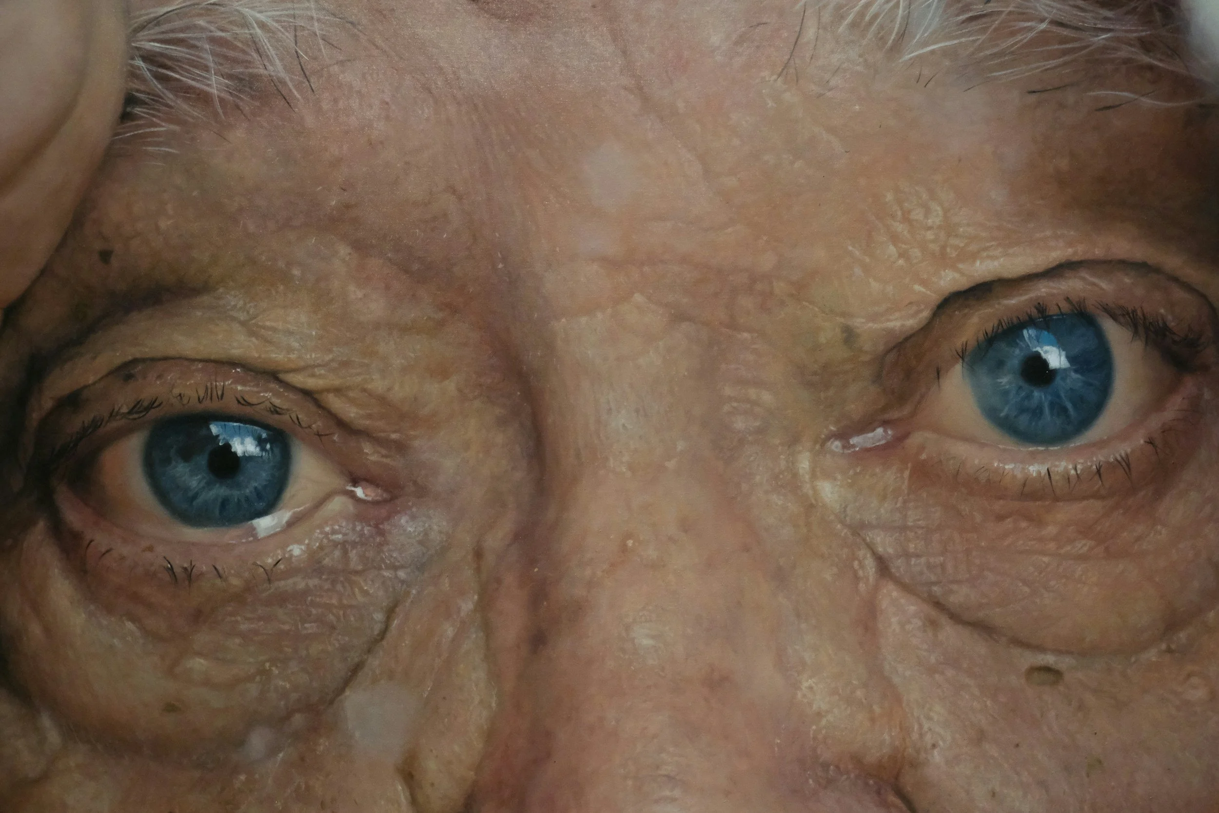 Enhancing Vision in Seniors Through Cataract Surgery