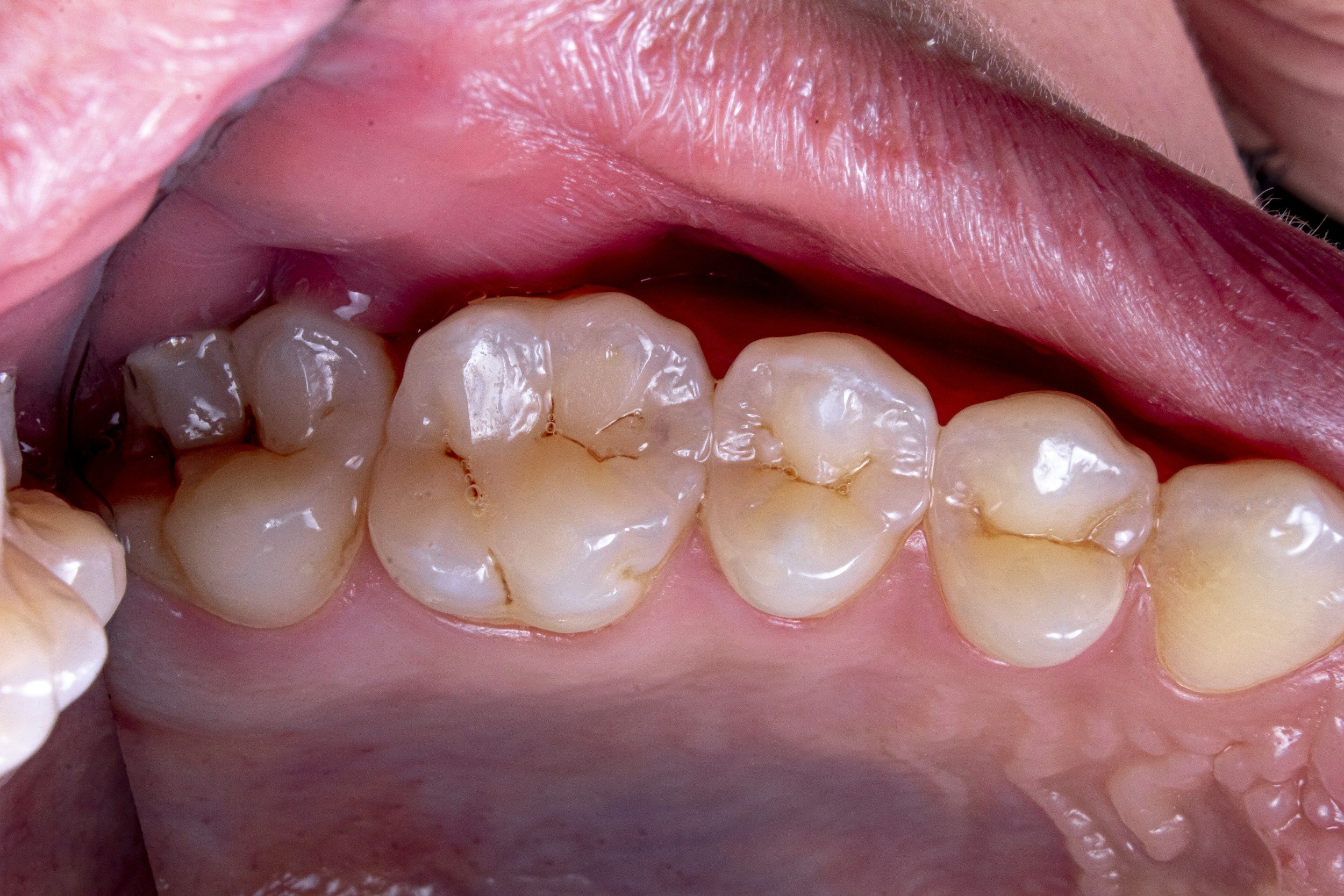 Understanding Periodontal Disease: Causes, Symptoms, and Care