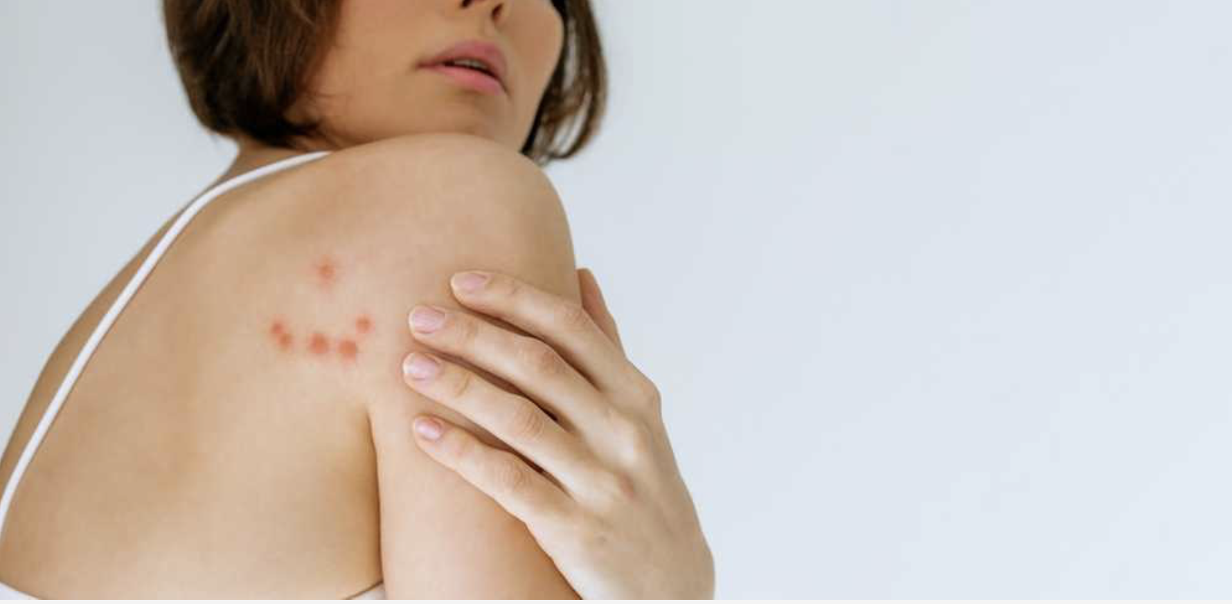 What to Do After Bedbug Bites: Legal Steps Every Tenant or Traveler Should Know